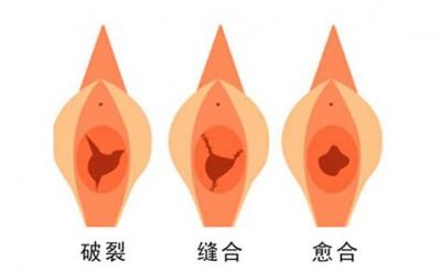女性应该要注意的妇科小常识有哪些,处女膜破裂怎么修复